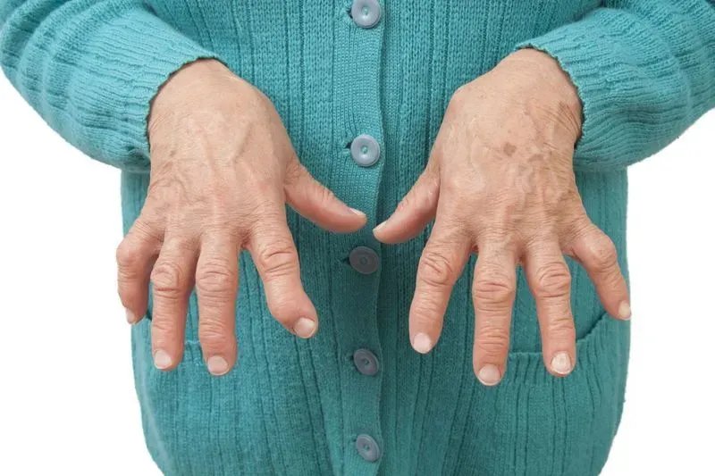 Чем лечить воспаление суставов на руках