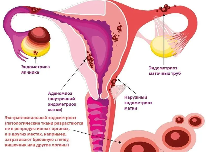 Как выявляется эндометриоз
