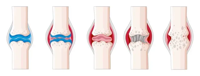Ревматоидный артрит фото коленного сустава