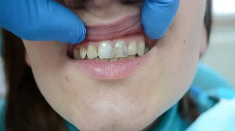 Болит зуб после установки пломбы при жевании