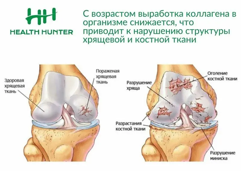 Артрит коленного сустава 1 степени