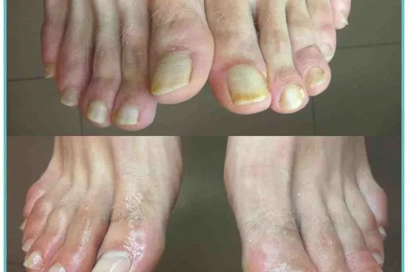 Грибок ногтей на ногах застарелый чем лечить