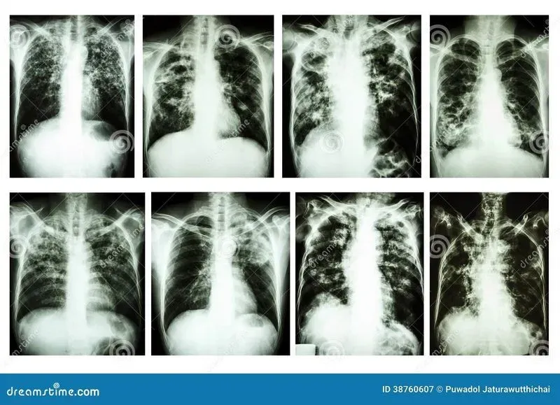 Туберкулез легких последствия