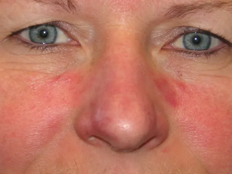 Кожные заболевания фото и описание на лице аллергия