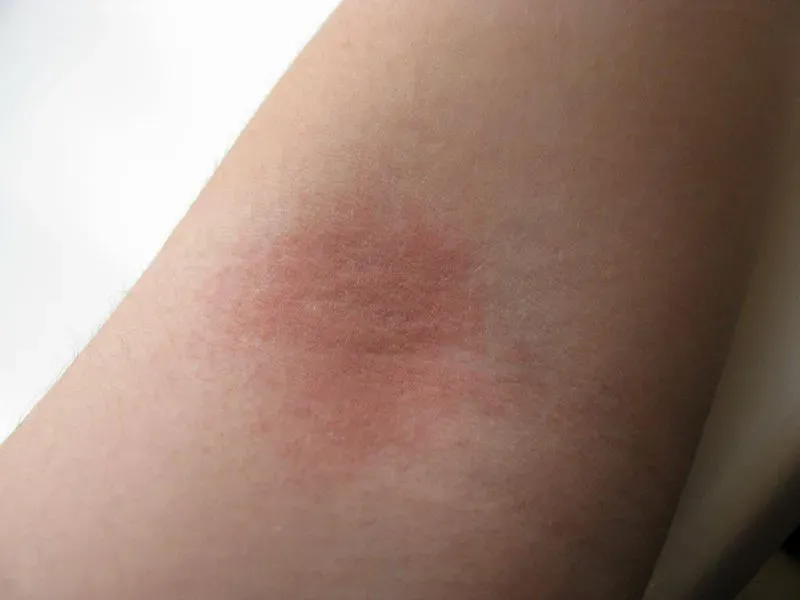 Аллергия на коже фото сыпь