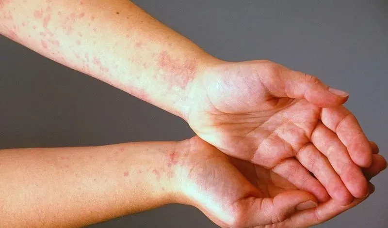 Виды аллергических высыпаний на коже