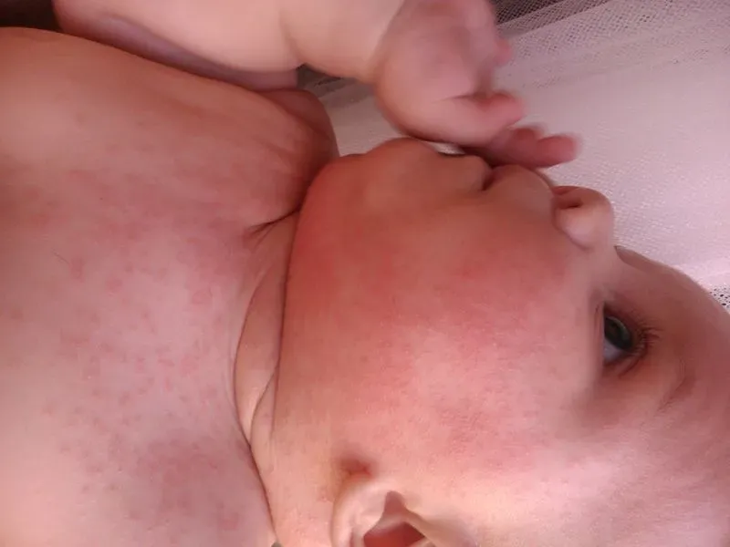 Аллергия на антибиотики у ребенка сыпь на коже
