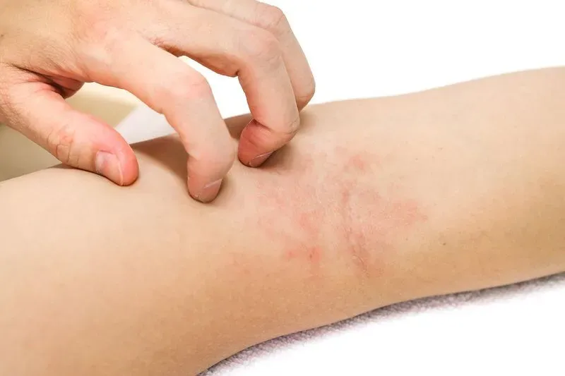 Аллергия фото на теле пятна