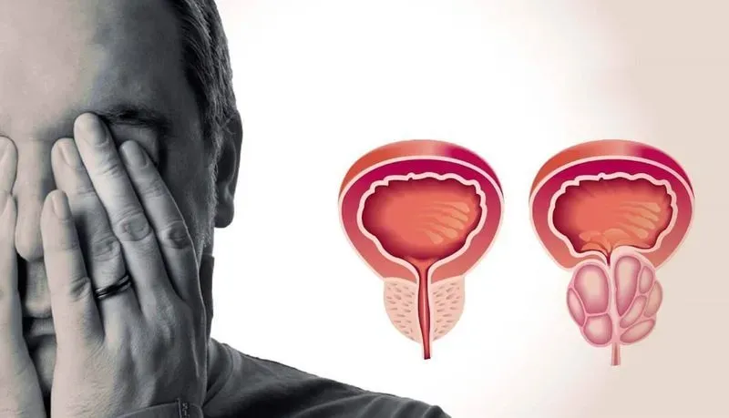 Видео признаки простатита у мужчин