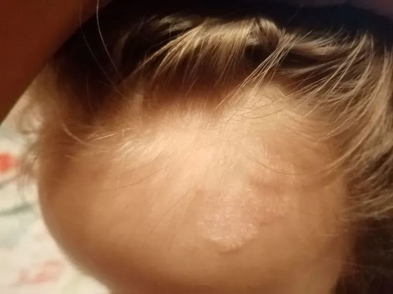 Болячки на лице у ребенка фото