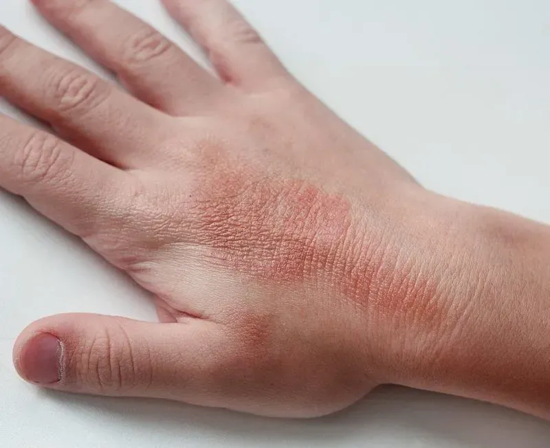 Аллергия на холод на руках симптомы и лечение