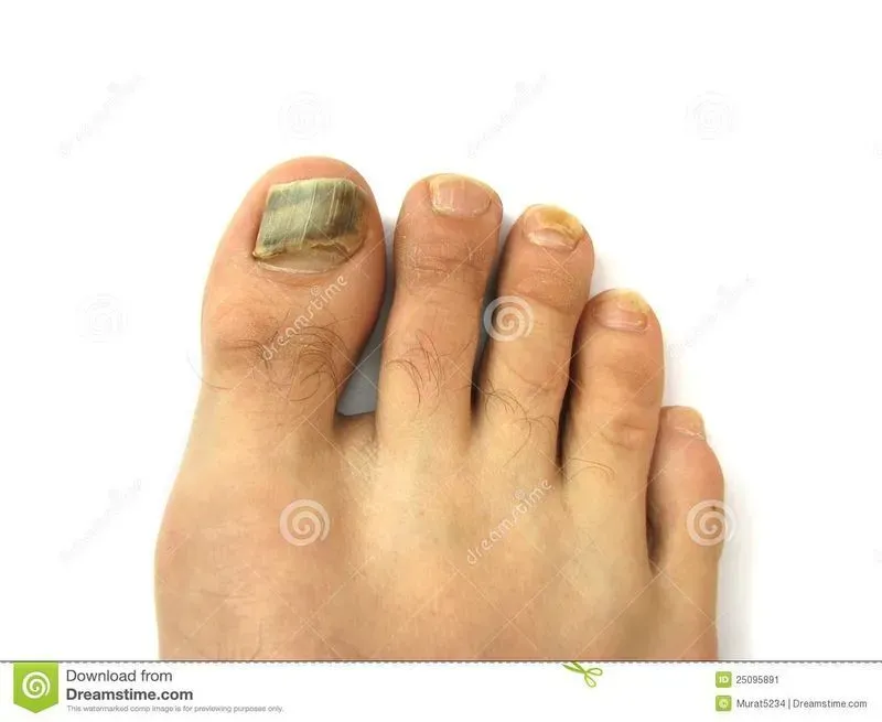 Болит ноготь на ноге большого пальца что делать