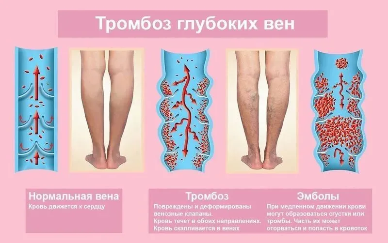 Лечение тромбов на ногах