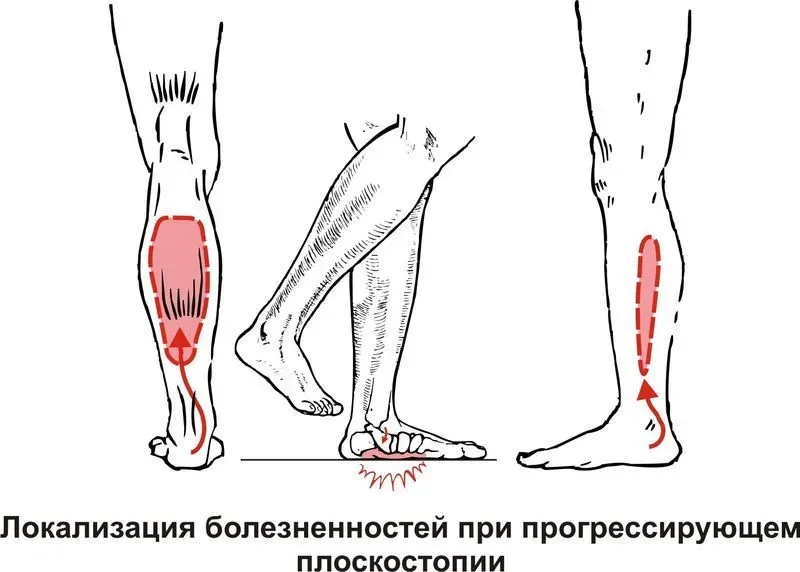 Почему мышцы ног сводит судорога