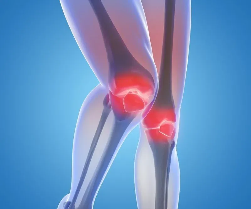 Артроз коленного сустава 2 степени симптомы и лечение