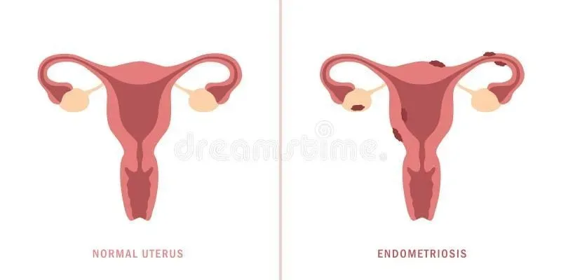 Эндометриоз при месячных