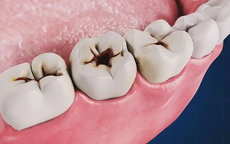 Чем лечить зубную боль в домашних условиях под пломбой