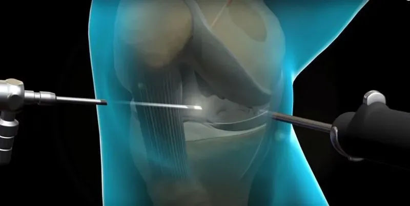 Артроскопия коленного сустава при артрозе 3 степени