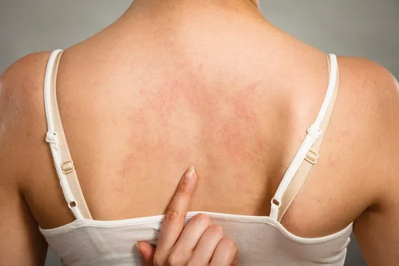 Аллергии на теле симптомы