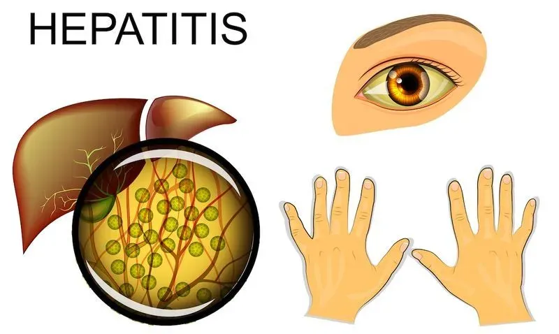 Симптомы гепатита в