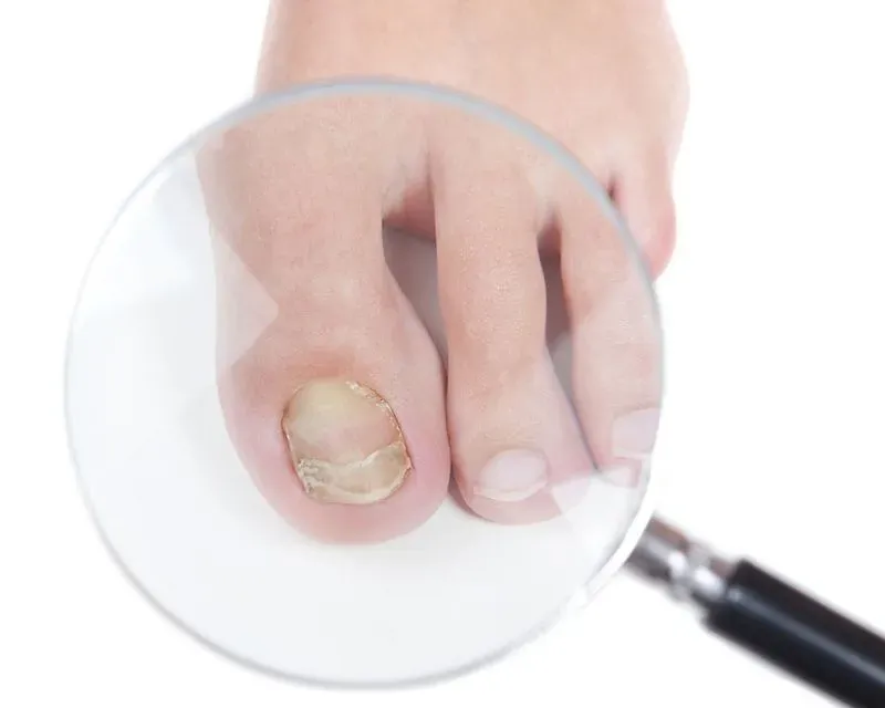 Лечение грибка ногтей на ногах в домашних условиях народными средствами