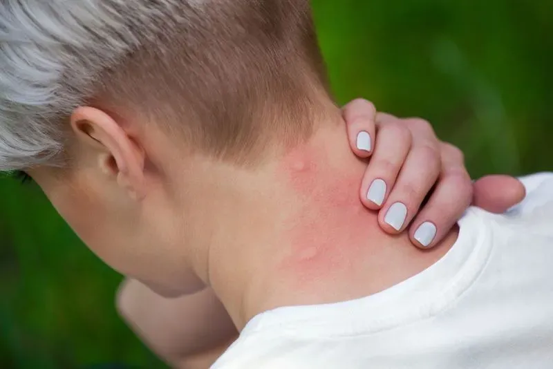 Как выглядит аллергия на теле человека фото
