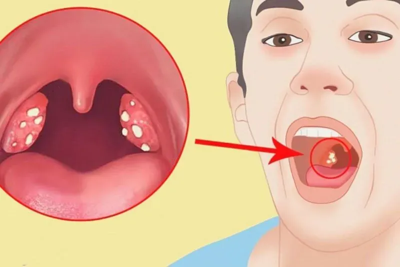 Во рту стафилококк лечение