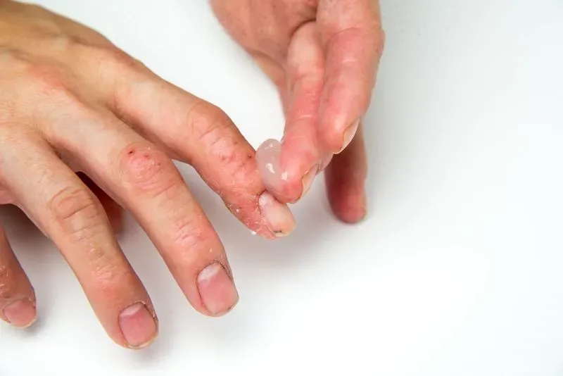 Чем вылечить дерматит на руках