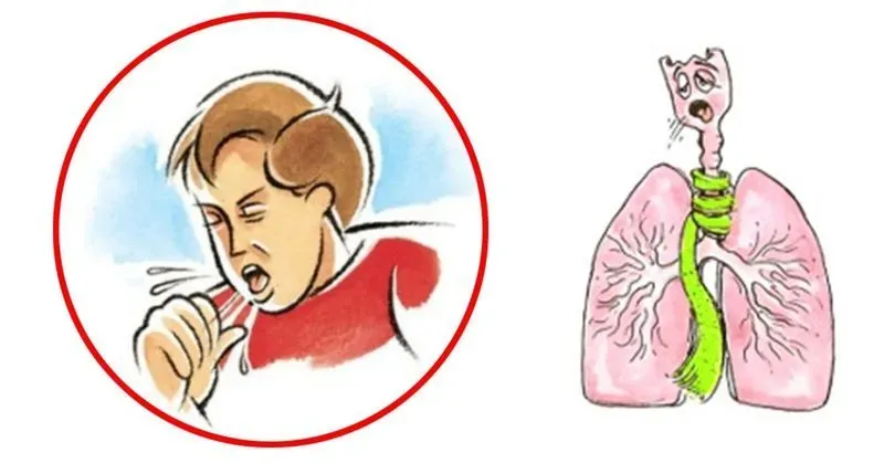 Сильный кашель как лечить