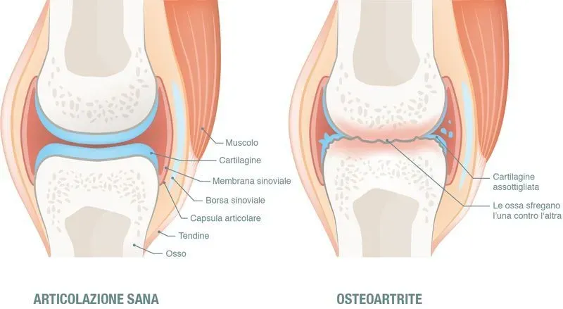Что такое умеренный синовит коленного сустава