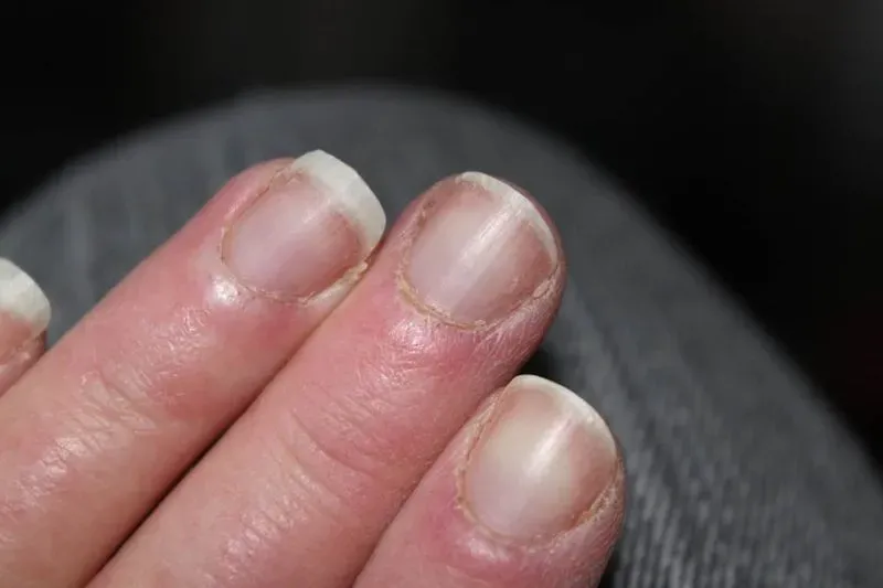 Трещины на пальцах рук у ногтей