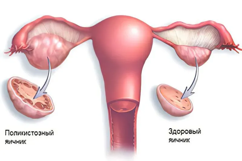 Какие симптомы воспаления яичников у женщин