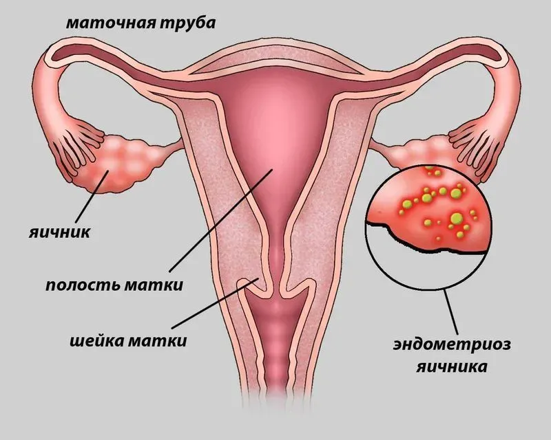 Эндометрия матки причины