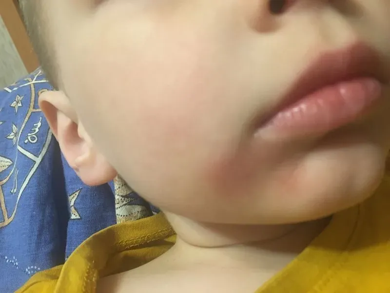 Аллергия у ребенка на губах фото
