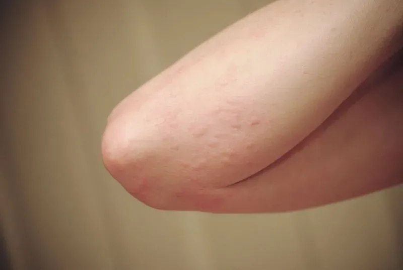 Высыпания на теле аллергия фото