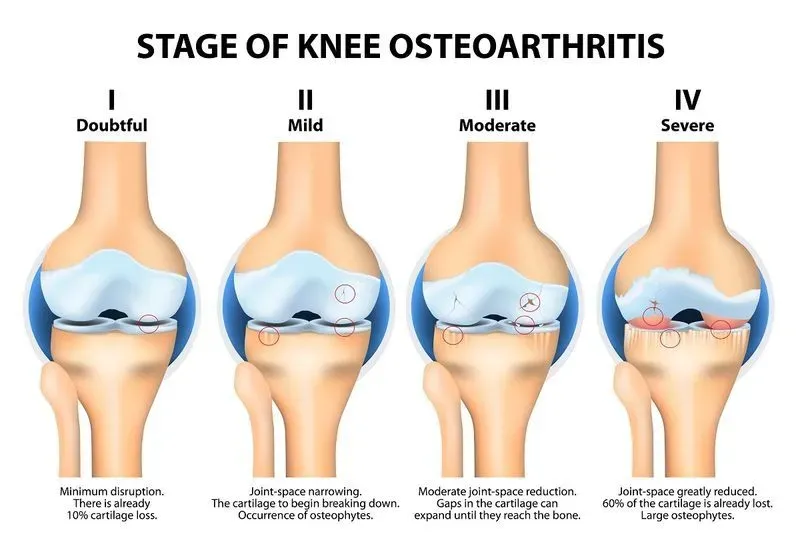 Артрит и артроз коленного сустава симптомы и лечение