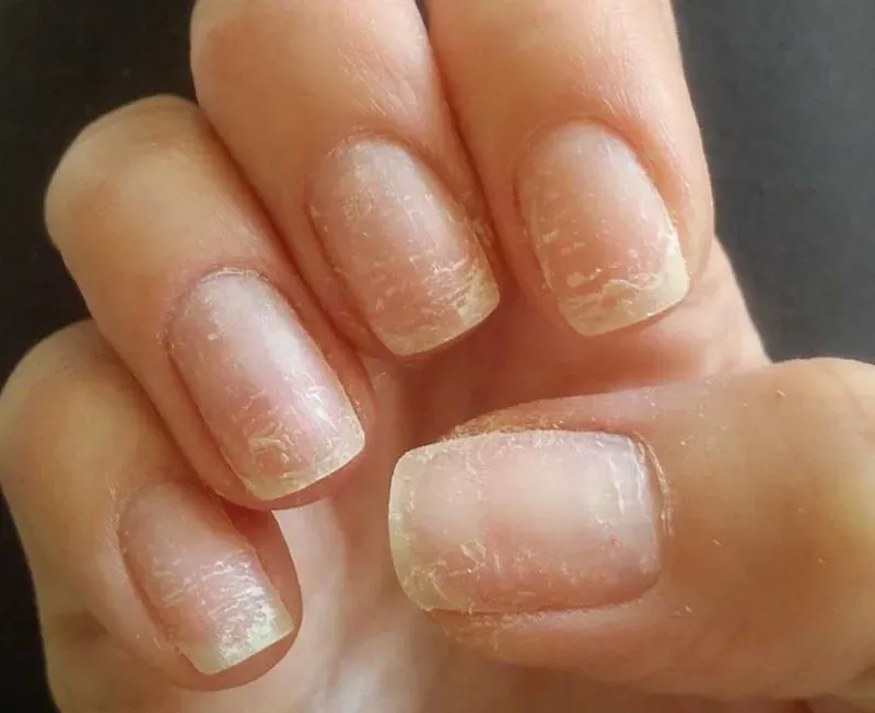 Как выглядит грибок на ногтях рук фото и чем лечить