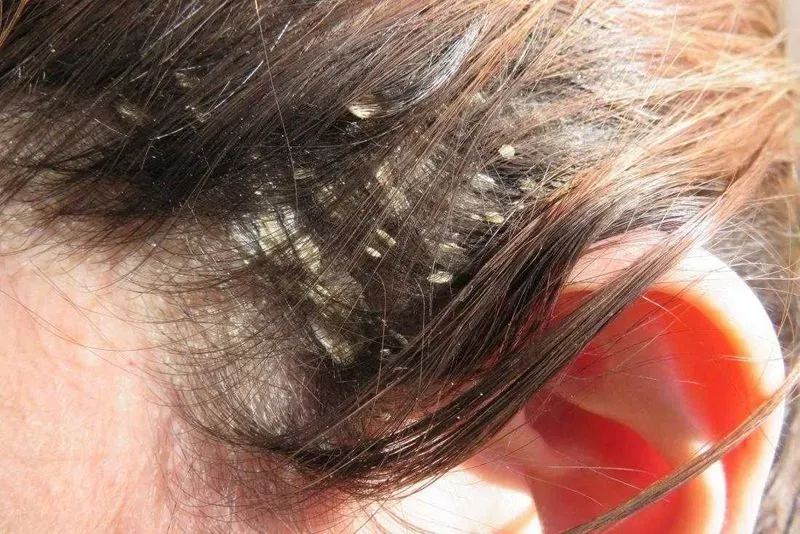 Лечение псориаза волосистой части головы в домашних условиях