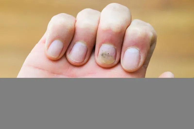Начальная стадия грибка ногтей на руках фото