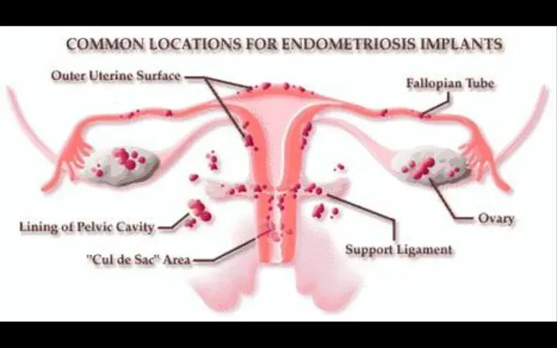Эндометриоз внутренний симптомы и лечение
