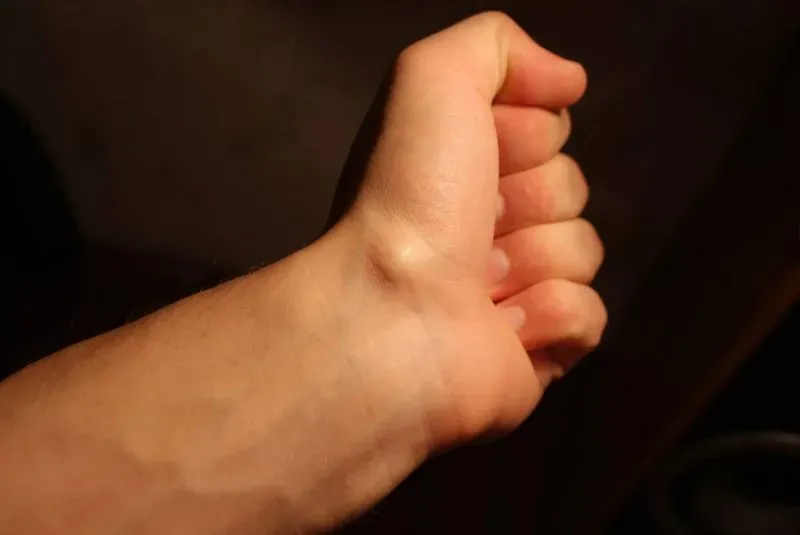 Большой палец на руке выскакивает из сустава