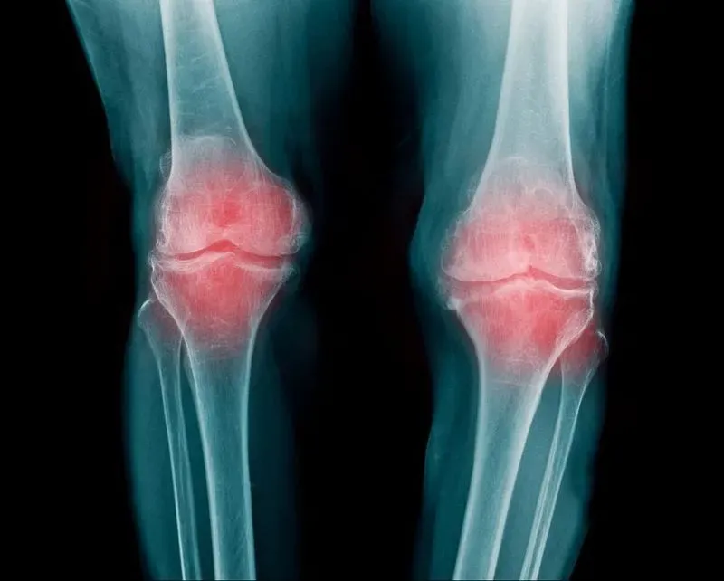 Ревматоидный артрит фото ноги