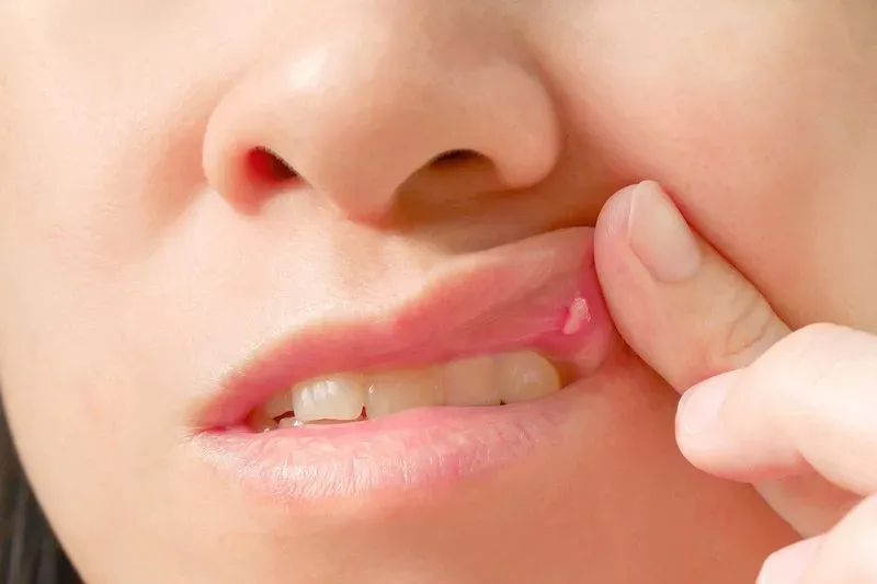 Стоматит фото на губе у детей