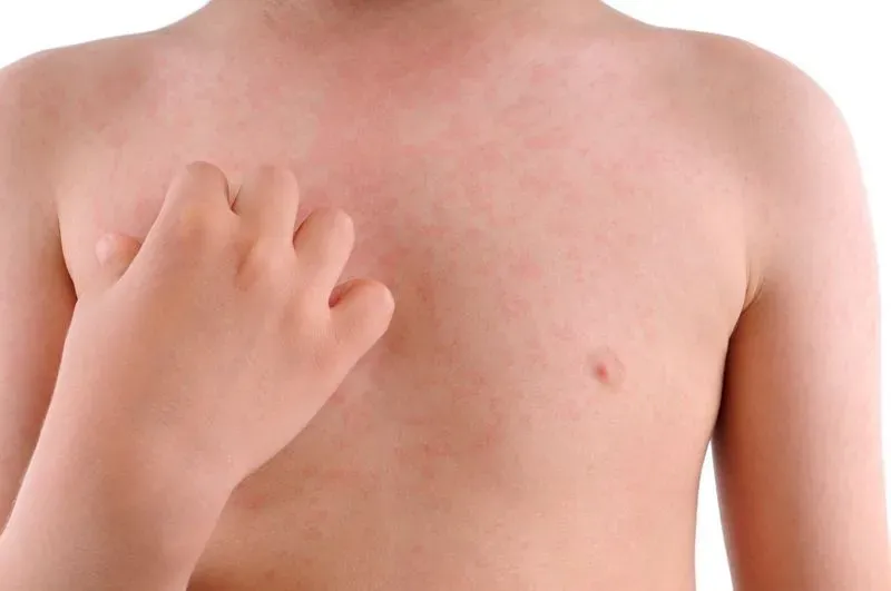 Аллергия на антибиотик фото у детей