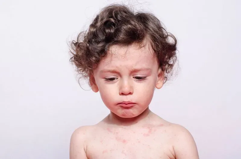 Что такое дерматит фото у детей