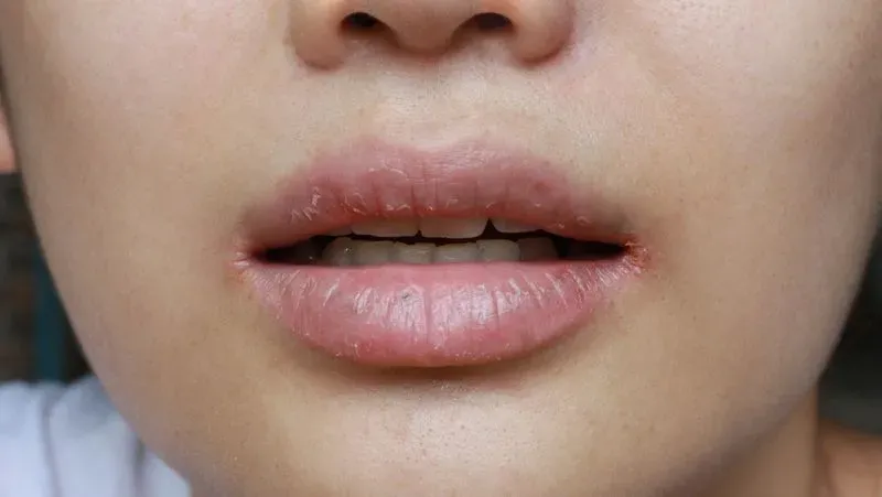 Трещинки в уголках губ у ребенка причины и лечение
